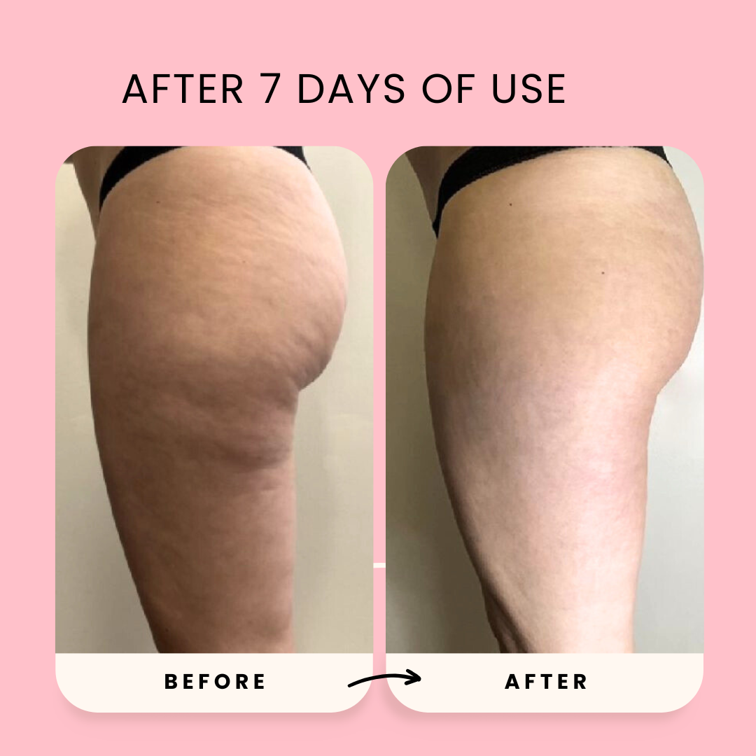 Anti-Cellulite Massager